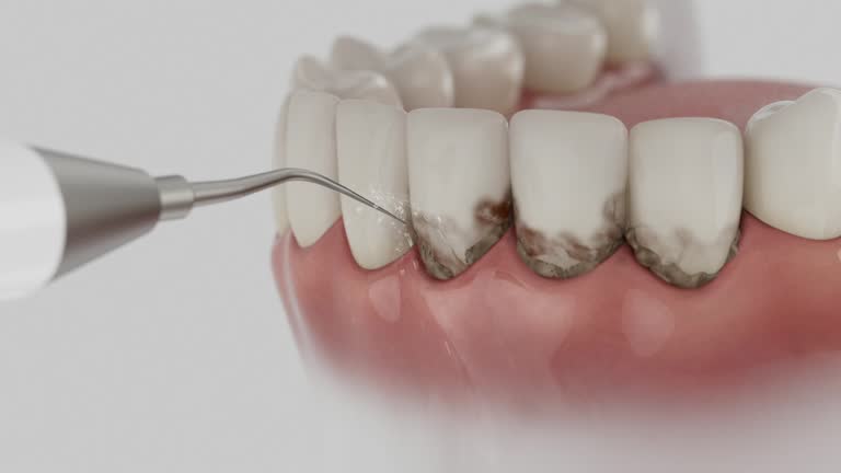 Trusted Wisdom Tooth Removal service in West Terre Haute, IN - Dentist Open Now
